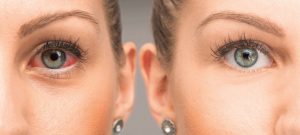 Similasan-pink-eyes-Tips
